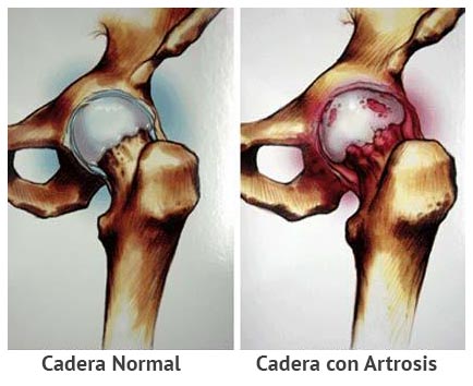 artrosis-cadera